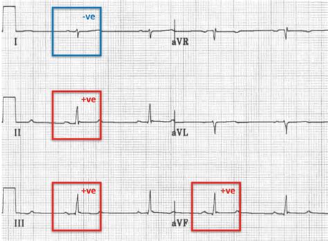 Right Axis Deviation (RAD) • LITFL • ECG Library Diagnosis